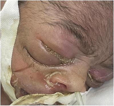 Ophthalmomyiasis in a preterm neonate resulting in blindness: A case report from Botswana